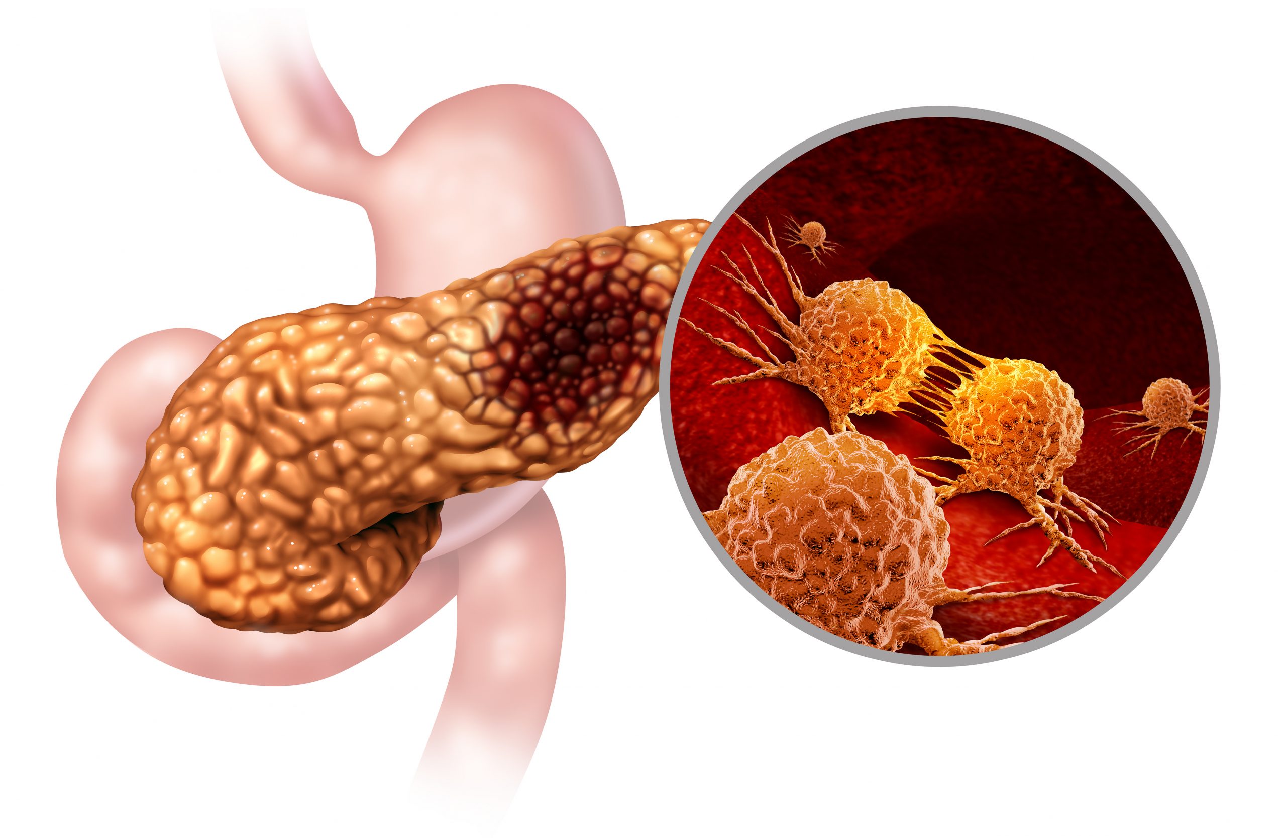 World-Renowned Oncologist Bullish on Potential of PharmaCyte’s Technology, Clinical Trial in Pancreatic Cancer